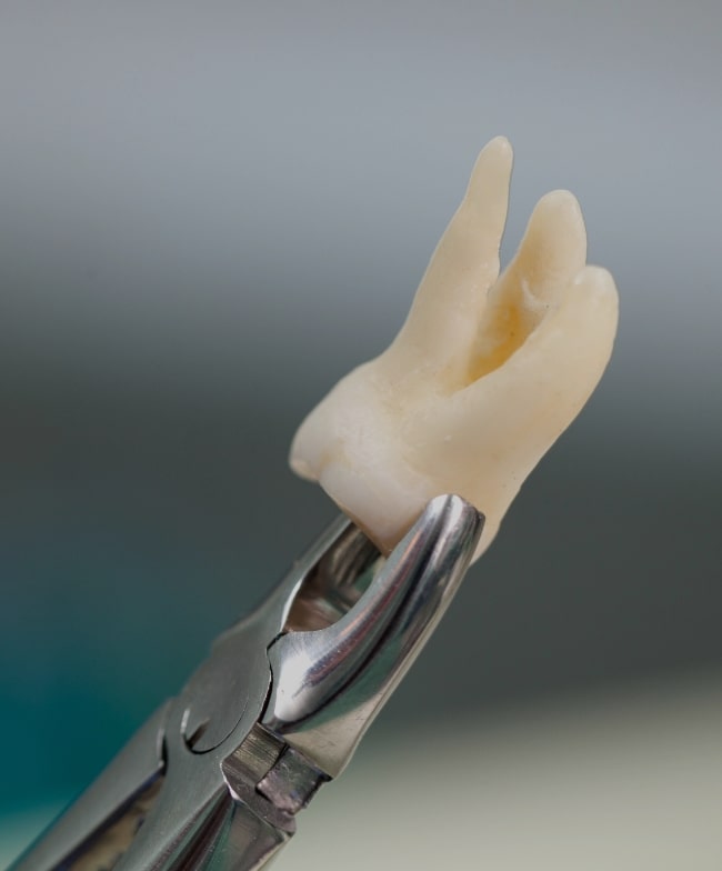 Treatment -  Smile & Beyond